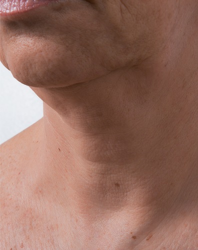 Viscoderm Neck - After